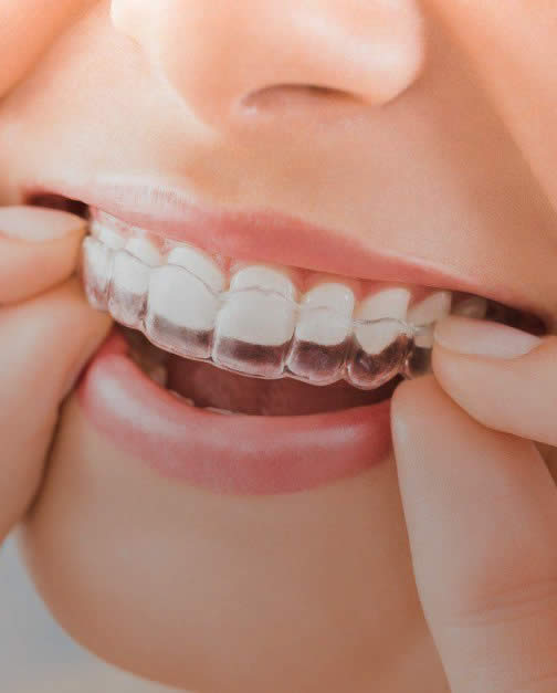 Close of invisalign clear bracket on teeth Close of invisalign clear bracket on teeth