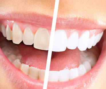 Current Trends in Teeth Whitening